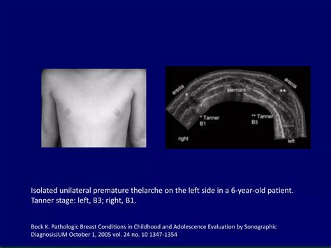 undeveloped tits|Pediatric and adolescent breast hypoplasia